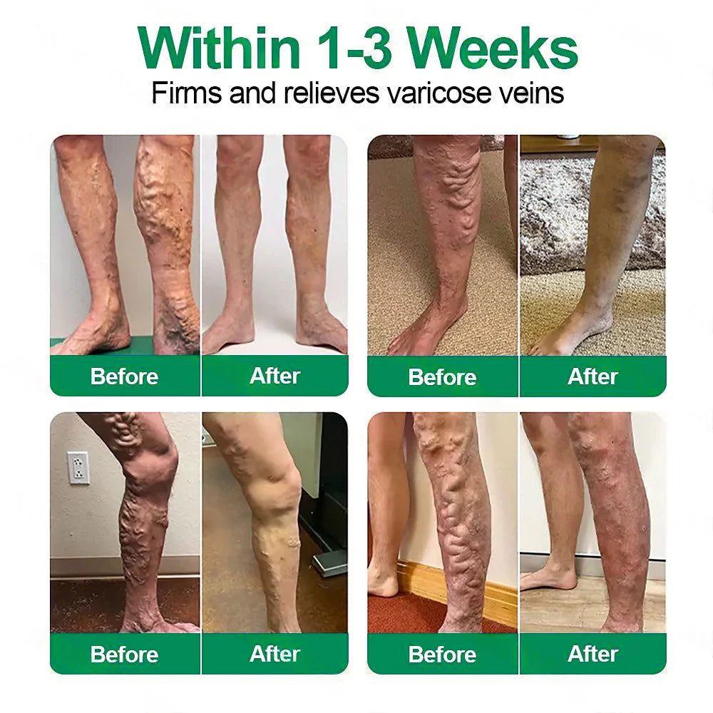 𝓞𝒇𝒇𝙞𝒄𝙞𝒂𝒍 𝑺𝒕𝙤𝒓𝓮 | 𝐅𝗹𝒐𝐫𝐢𝒔𝗺𝙖® 𝐕𝗲𝐢𝐧𝐓𝙖𝐫𝐠𝗲𝐭 𝐍𝒂𝐧𝐨 𝐌𝐢𝐜𝐫𝐨𝐧𝗲𝗲𝐝𝗹𝐞 𝐏𝙖𝐭𝐜𝐡🌿Instant Relief, Long-Term Results